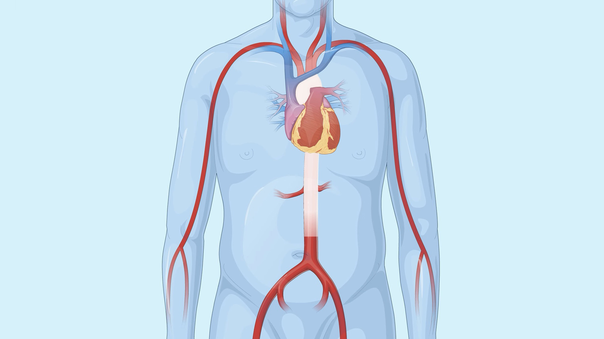 Abdominal Aortic Aneurysm: Endovascular Repair