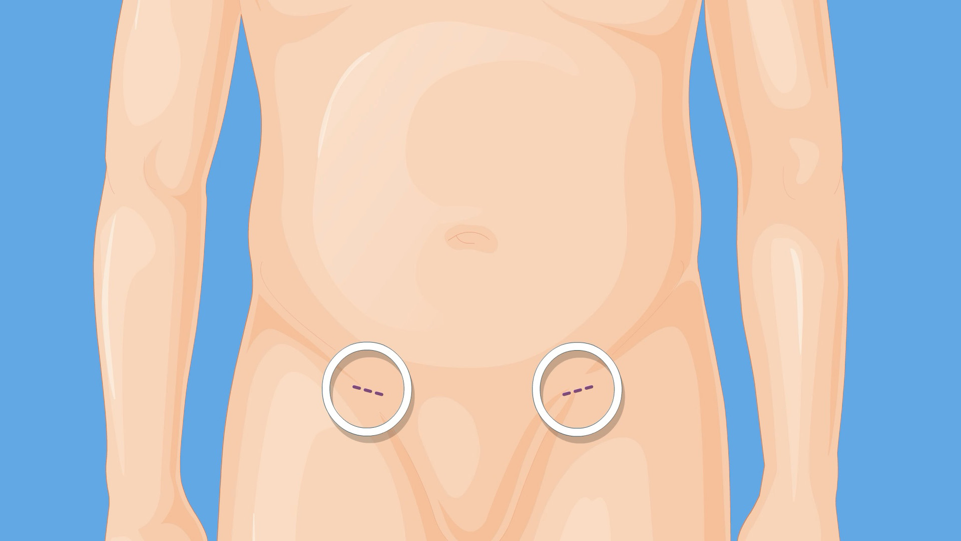 What Is an Abdominal Aortic Aneurysm (AAA)?: Overview