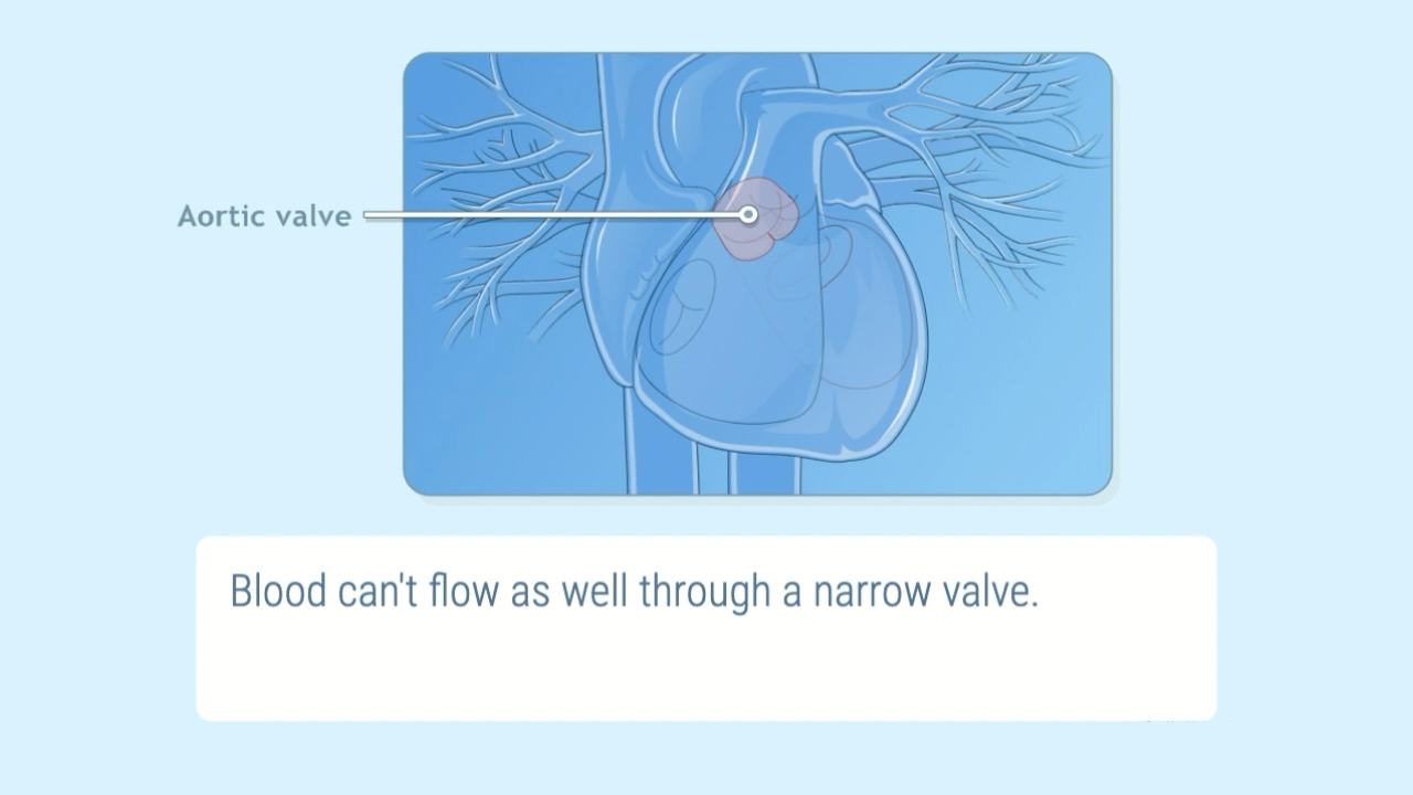 Aortic Valve Replacement