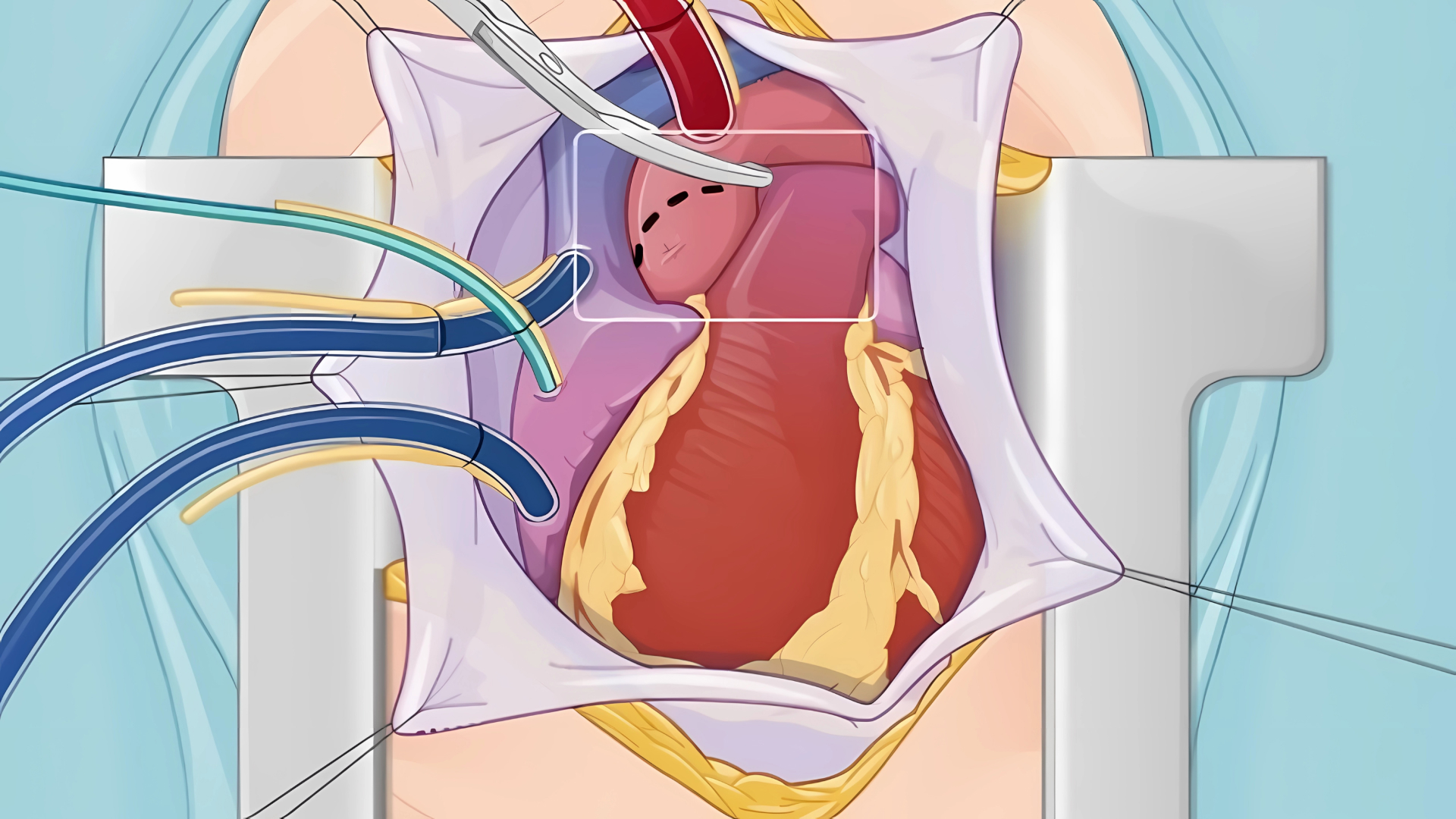 What Happens During an Aortic Valve Replacement?: Overview
