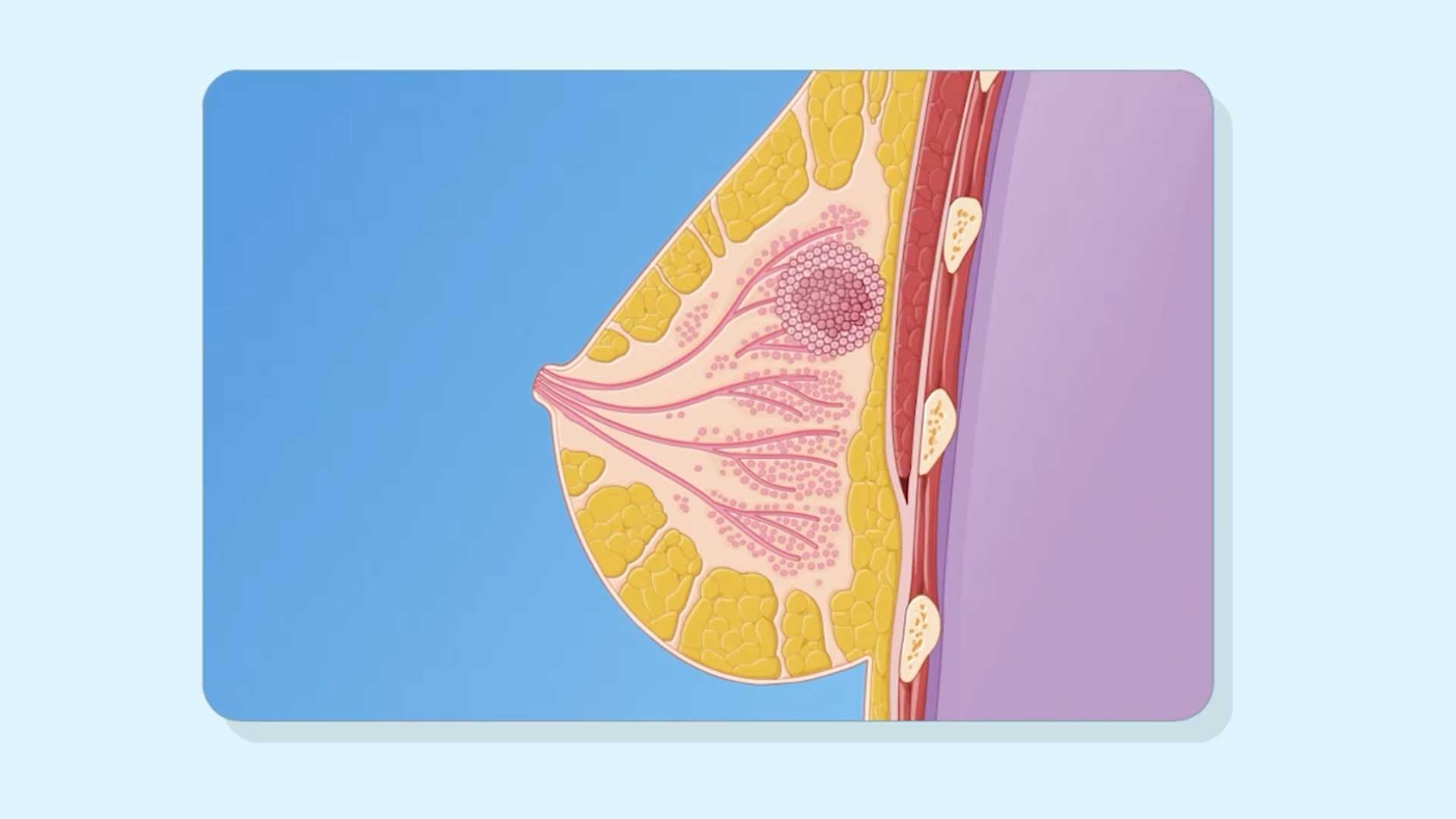 Breast Cancer: Overview